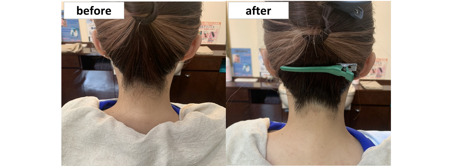 女性用シェービングバナー