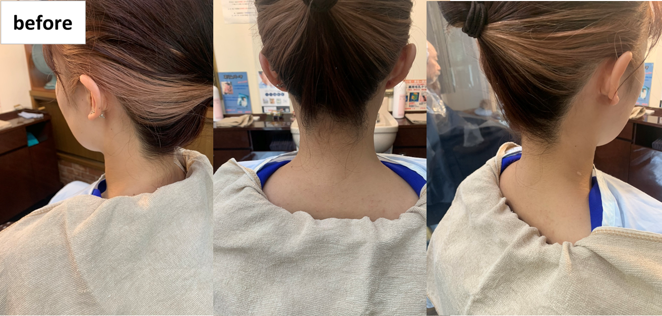 シェービング施術前写真