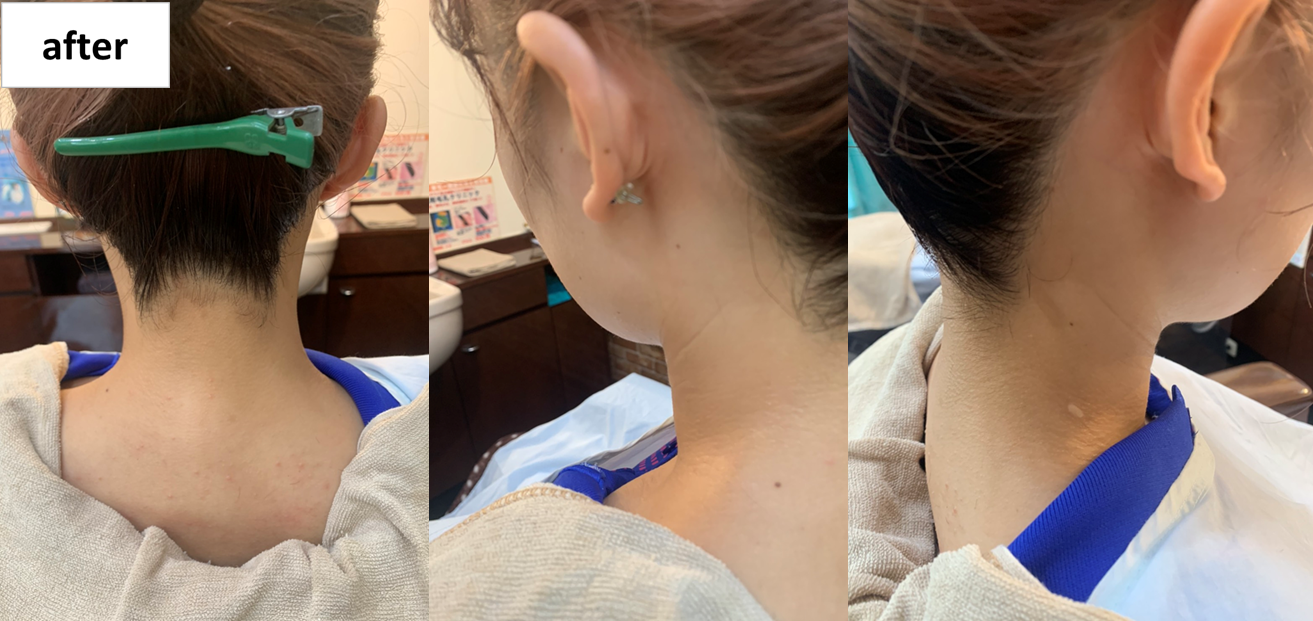 シェービング施術後写真